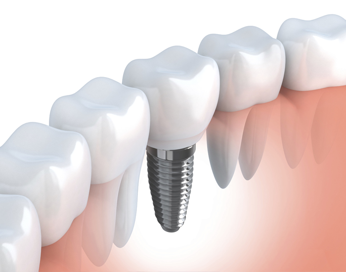 A picture of dental implants