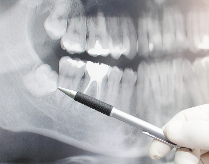 An x-ray of wisdom teeth before oral surgery